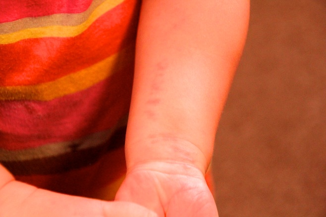 Shingles?